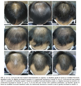 Read more about the article Male hair loss treatments: I think they work